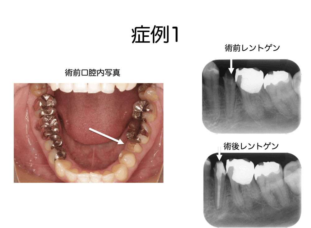 根管治療中の痛みについて part1 なかなか終わらない根管治療