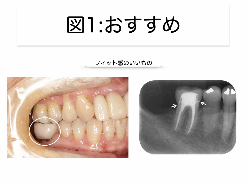 根管治療後のかぶせ物について part2 ～経過良好になるために～