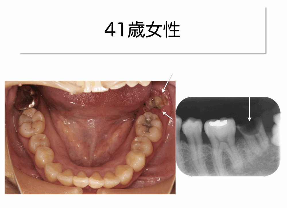 歯のかぶせ物の重要性(根管治療後のかぶせ物についてpart3)