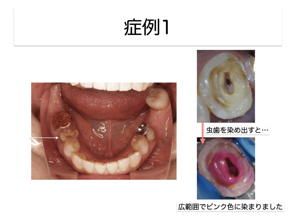 『根管治療の途中で痛みが出たから薬を詰められない』このままでいいの？