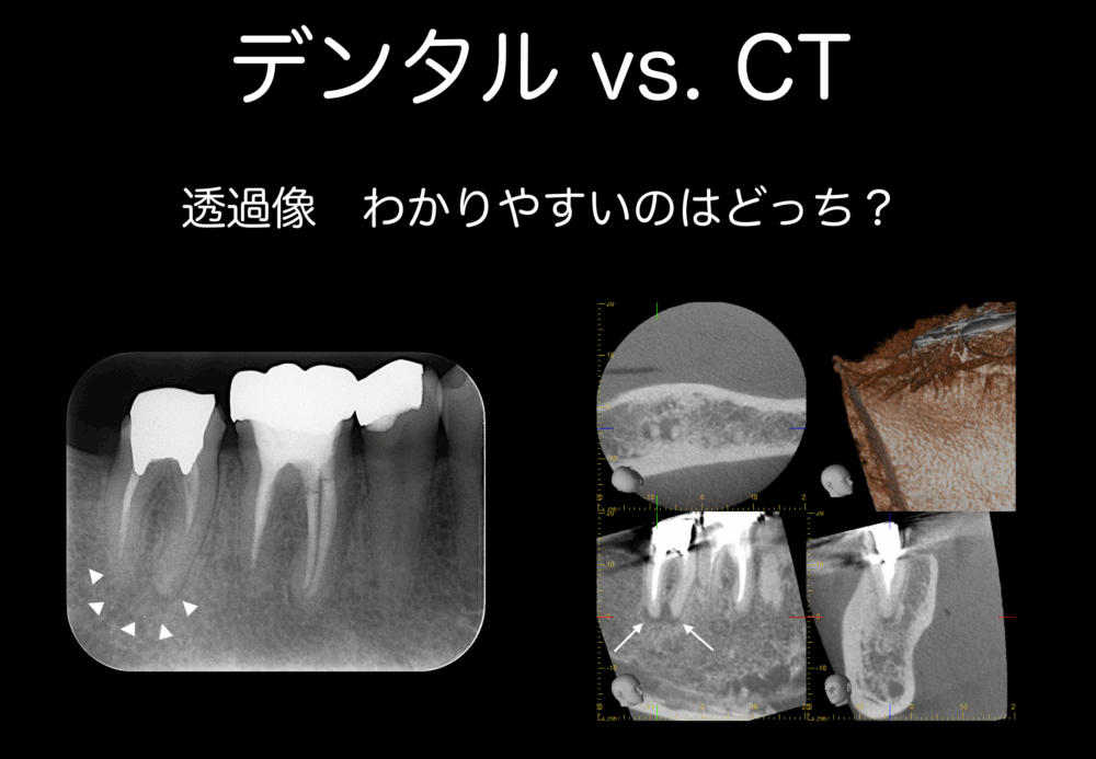 根管治療にCTは必要でしょうか？？