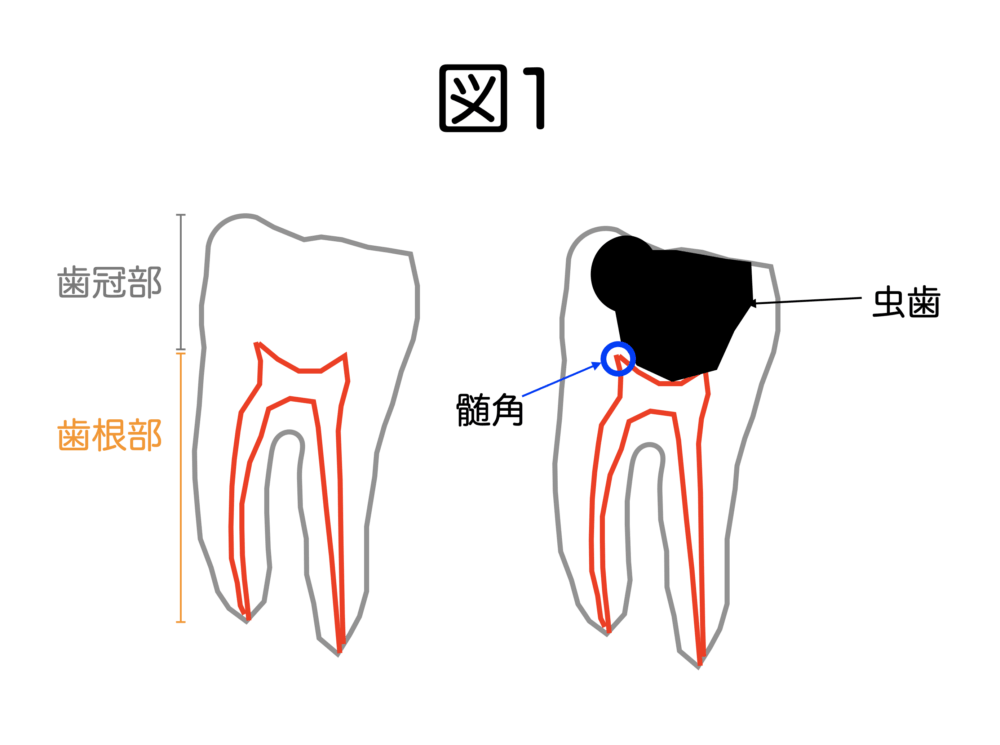 根管治療を失敗させない＝成功させる要件〜その３〜