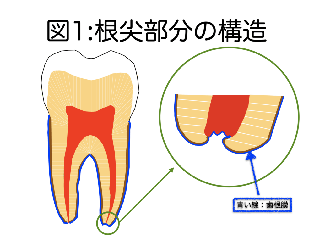 根管治療を失敗させない＝成功させる要件〜その5〜