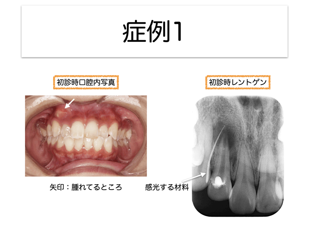 根管治療を失敗させない＝成功させる要件〜その6〜