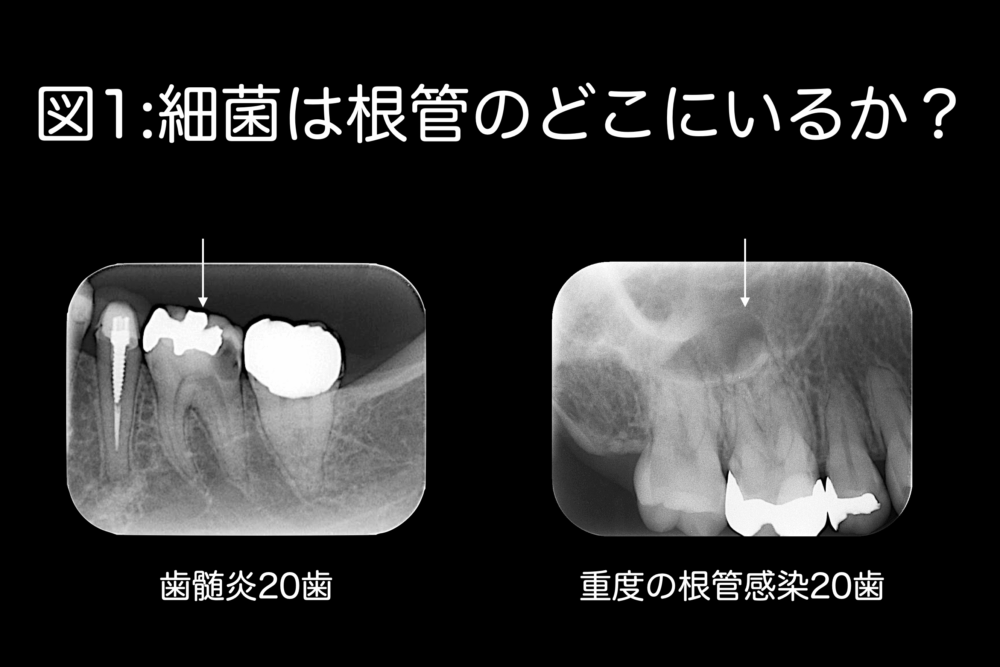 根管治療を失敗させない＝成功させる要件〜その4〜