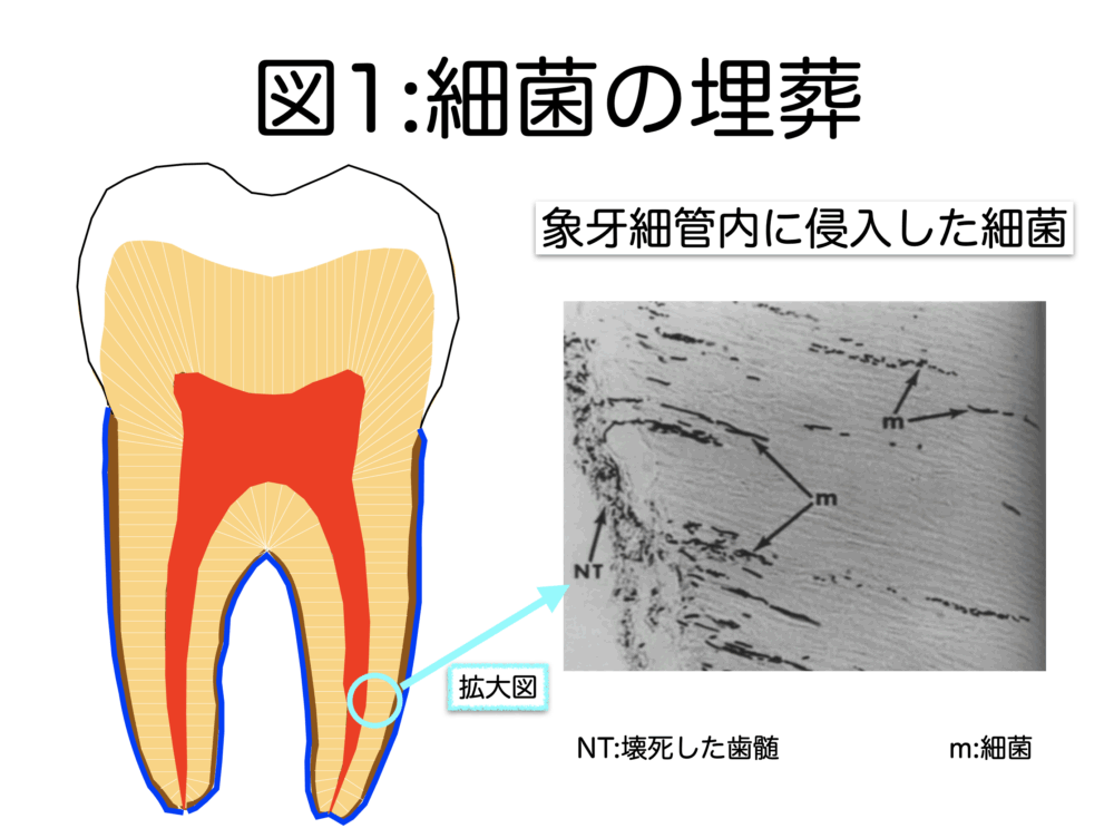 根管治療を失敗させない＝成功させる条件　その7 根管充填について