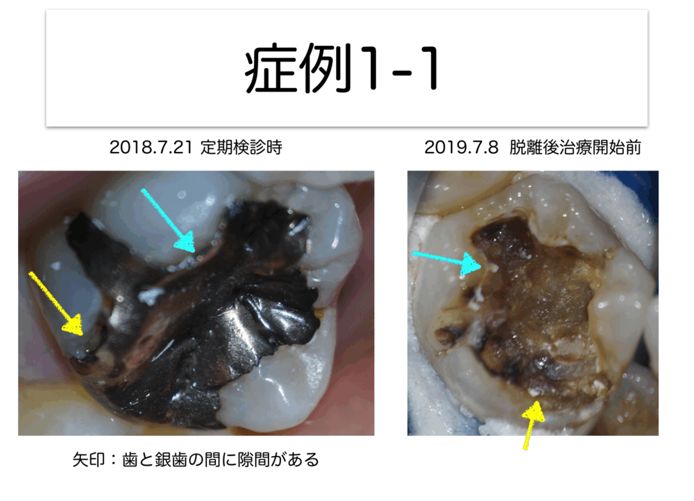 歯をもたせるための、豆知識〜その3 虫歯編② 歯髄の保存とかぶせ物のフィット感について〜