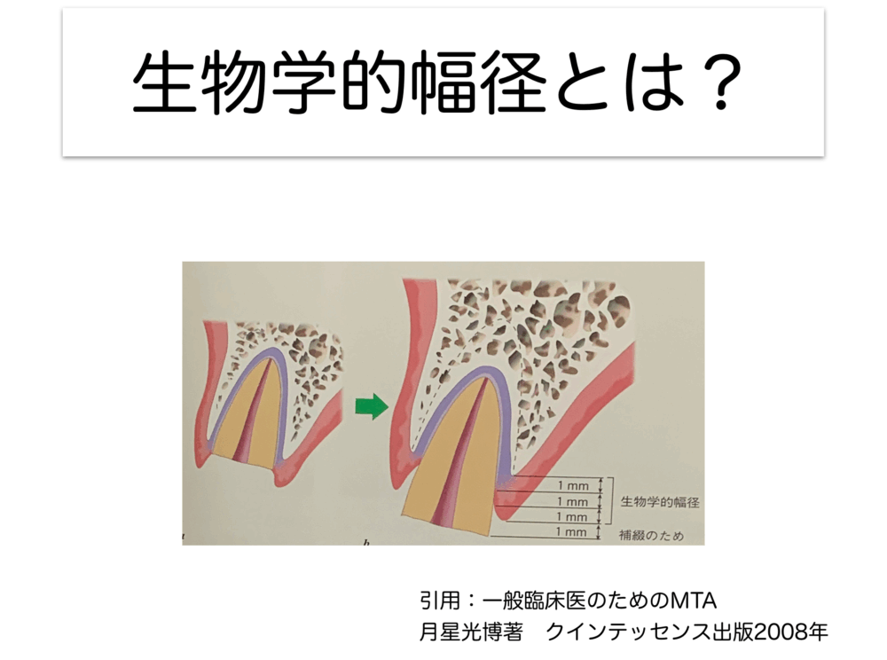 矯正的挺出をなぜ行うか〜生物学的幅径の確保１〜