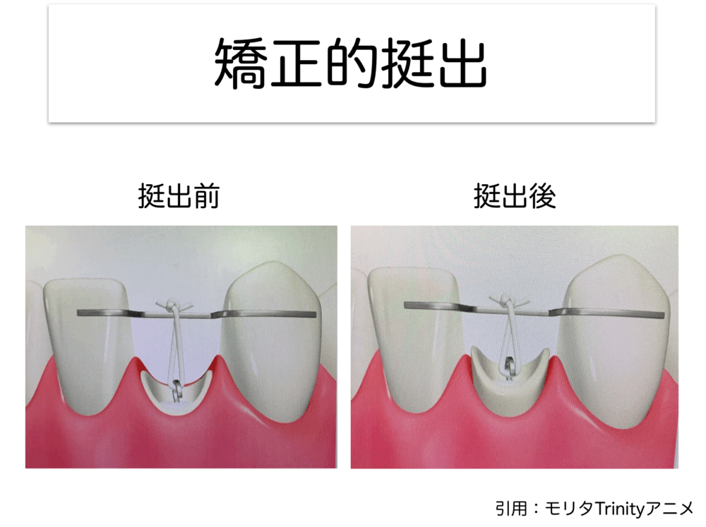挺出(エクストルージョン)について