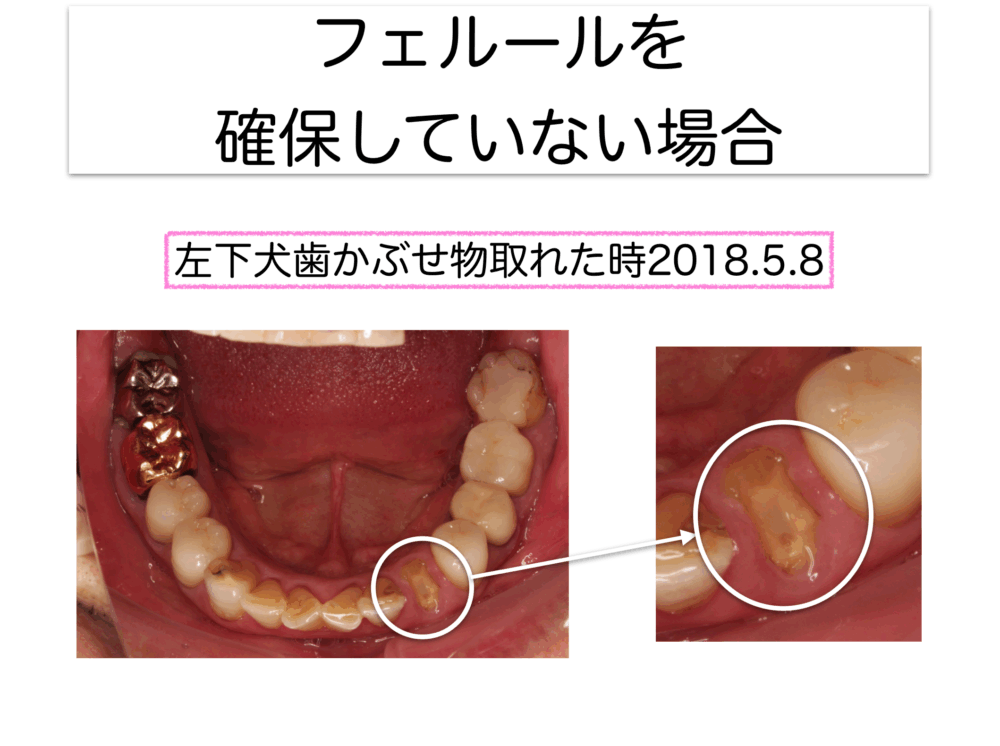 矯正的挺出をなぜ行うか〜フェルールの確保1〜