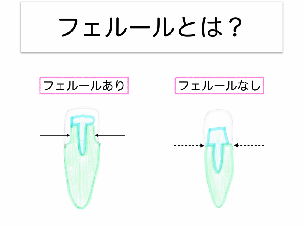 矯正的挺出をなぜ行うか〜フェルールの確保2〜
