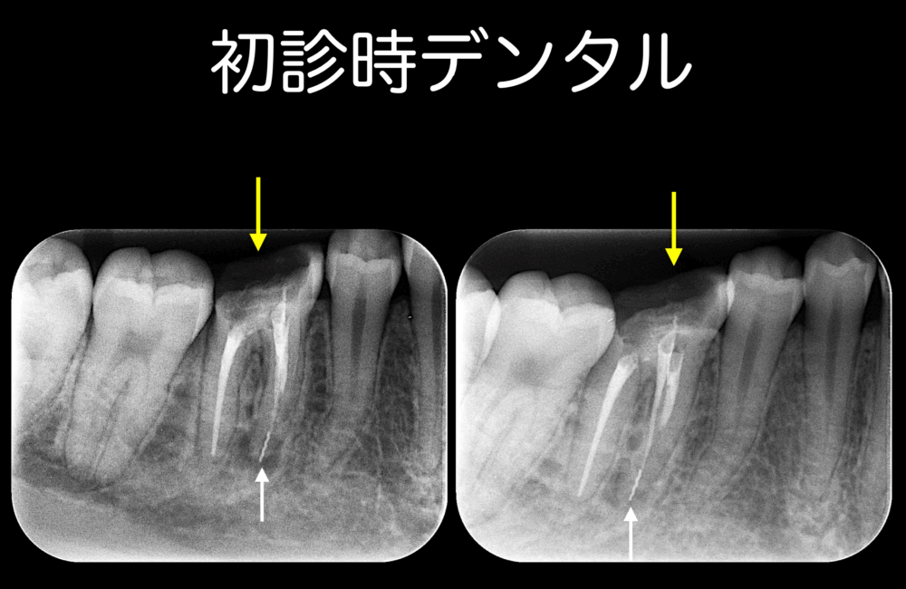 そもそもその歯に根管治療は必要か？〜パート２〜