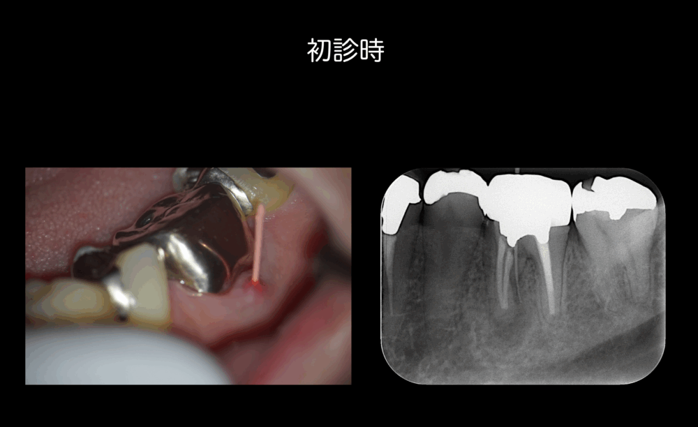 ももこ歯科での根管治療〜サイナストラクトは治るのか〜