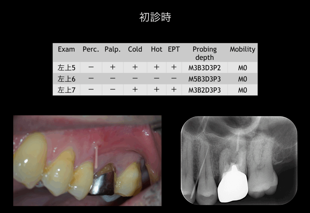 ももこ歯科での根管治療２〜サイナストラクトは治るのか２〜
