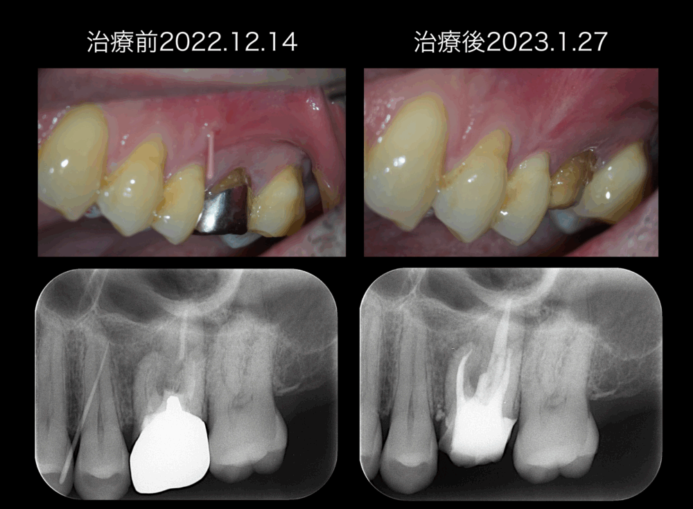 ももこ歯科での根管治療３〜サイナストラクトは治るのか２のつづき〜