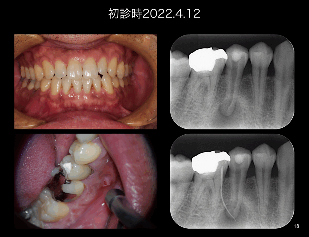 ももこ歯科での根管治療４〜サイナストラクトは治るのか 症例３〜