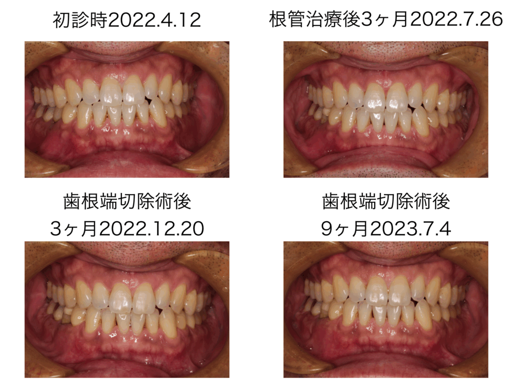 ももこ歯科での根管治療５〜サイナストラクトは治るのか 症例３歯根端切除術編〜