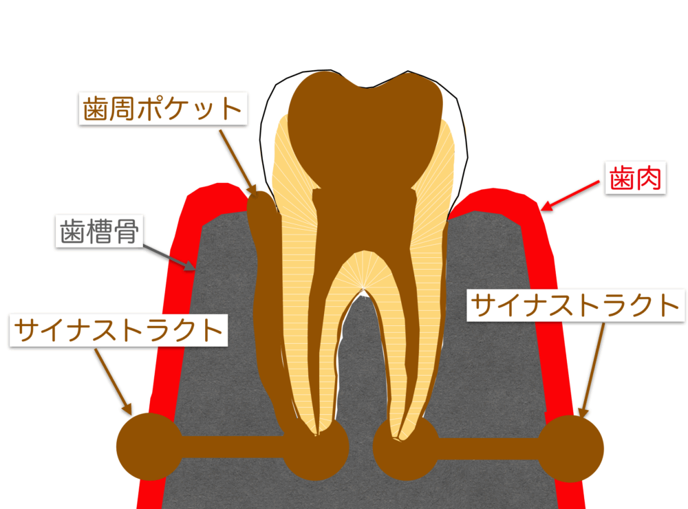 歯内歯周病変について