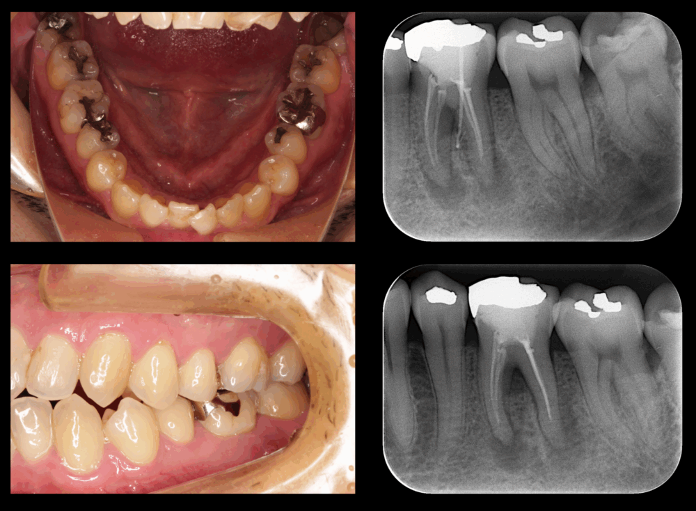 ももこ歯科での根管治療６〜サイナストラクトは治るのか 症例４歯内歯周病変編〜