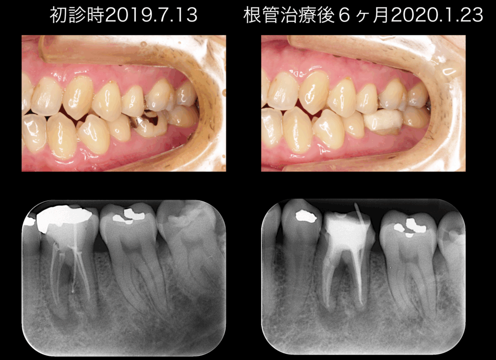 ももこ歯科での根管治療7〜サイナストラクトは治るのか 症例４歯内歯周病変編〜