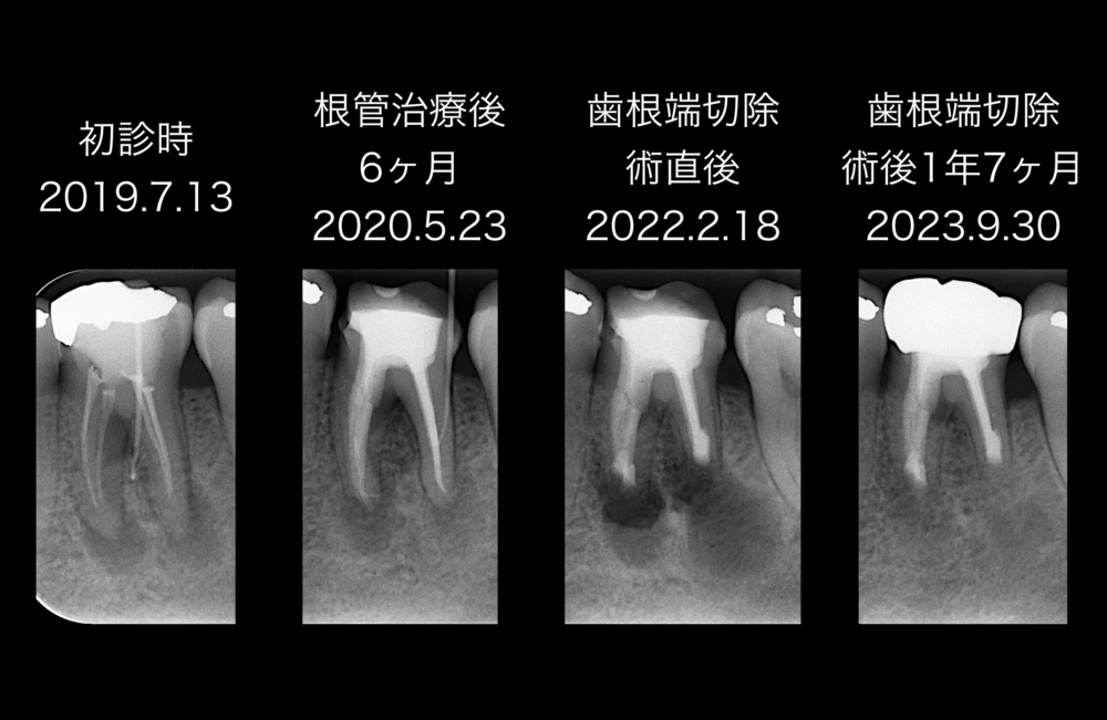 ももこ歯科での根管治療8〜サイナストラクトは治るのか 症例４歯内歯周病変編〜