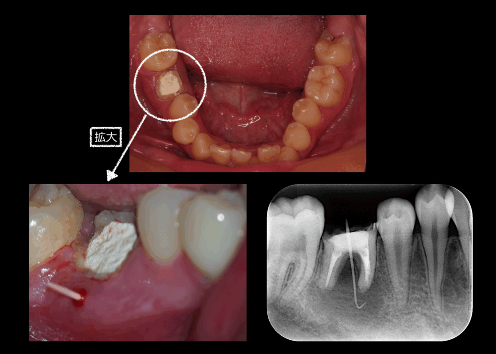 根管治療ではなく抜歯を選んだ17歳男性