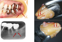 レントゲンで歯の周りが真っ黒になっているのは、膿がたまっているから、と言われました。膿が大きいともう手遅れでしょうか?