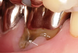 原因不明の『かむと痛い』の正体は、歯がヒビ割れていた?- partⅡ-〜経過不良編〜