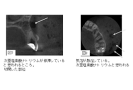 根管治療で使う薬剤の注意事項〜次亜塩素酸ナトリウムと水酸化カルシウムの危険性について〜