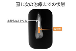 根管治療の間隔と、抗菌効果の持続期間について